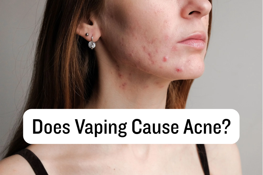 Does Vaping Cause Acne?