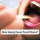 Does Vaping Cause Tonsil Stones?