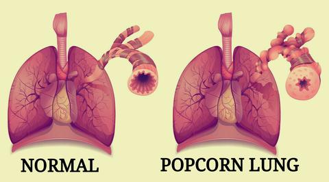 popcorn lung